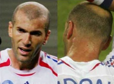 サッカー選手の髪型 ハゲが進んだ有名な海外の選手まとめ 男の髪型特集